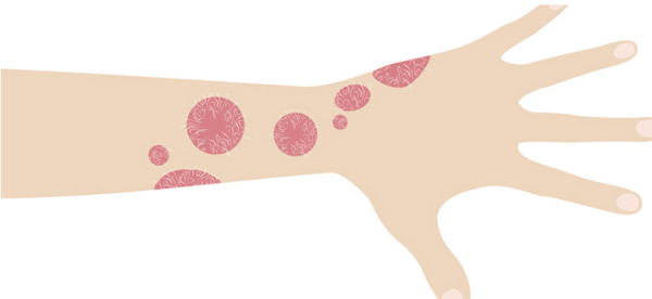 Symptômes causes et traitements d’un herpès circiné